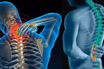 Chữa gai cột sống với những bài thuốc dân gian cực đơn giản