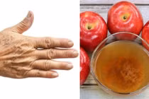 Làm cách này, đốm đồi môi trên da sẽ hết trong nháy mắt