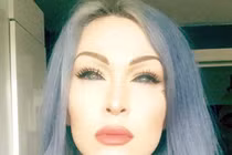 Gái trẻ suýt mù vì ham hố xăm màu mắt