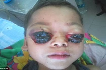 Cậu bé 4 tuổi mắc bệnh lạ mắt rồi như rớt ra ngoài