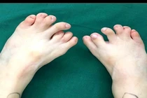Hy hữu bé gái có 13 ngón chân vì dị tật bẩm sinh