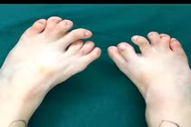 Hy hữu bé gái có 13 ngón chân vì dị tật bẩm sinh