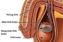 Bài thuốc hữu hiệu chữa viêm tinh hoàn từ cỏ cây dễ kiếm