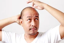5 căn bệnh đàn ông hói đầu dễ mắc phải
