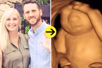 Mẹ đau đớn sinh con không não để cứu con người khác