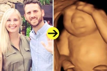 Mẹ đau đớn sinh con không não để cứu con người khác