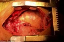 Kỳ lạ hai trái tim chung nhịp đập trong cùng một cơ thể 