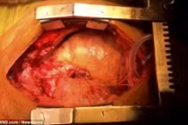 Kỳ lạ hai trái tim chung nhịp đập trong cùng một cơ thể 