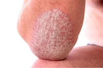 7 bài thuốc dân gian chữa bệnh vảy nến hiệu quả