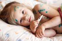 Bài thuốc dân gian trị thủy đậu đơn giản tại nhà