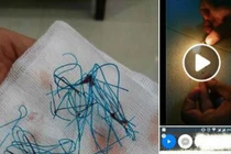 Nâng mũi bằng chỉ vàng 24k thiếu nữ nhận cái kết đắng