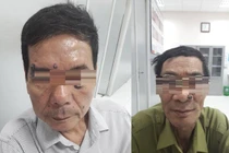 Hà Nội: Đi đốt nốt ruồi, 2 người đàn ông bất ngờ phát hiện ung thư