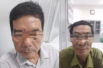 Hà Nội: Đi đốt nốt ruồi, 2 người đàn ông bất ngờ phát hiện ung thư