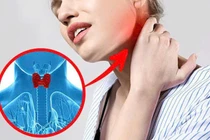Bệnh tuyến giáp ngày càng tăng, phòng ngừa thế nào?