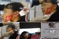 Nữ sinh lớp 11 bị rạch mặt, anh trai lên tiếng cầu cứu