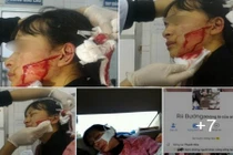 Nữ sinh lớp 11 bị rạch mặt, anh trai lên tiếng cầu cứu