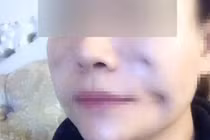 Tham làm đẹp giá rẻ người lõm mặt, người chằng chịt sẹo lồi 