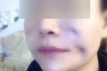 Tham làm đẹp giá rẻ người lõm mặt, người chằng chịt sẹo lồi 