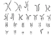 Những người bị dị tật bẩm sinh kỳ lạ nhất thế giới