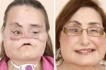 Kinh điển loạt ca phẫu thuật từ “mặt quỷ” thành mặt người