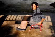 Quý ông chân to như cột đình vì mắc bệnh lạ