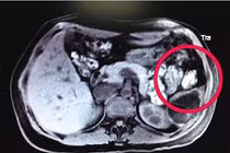 Hoảng hồn phát hiện bào thai lạc trên lá lách