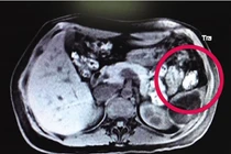 Hoảng hồn phát hiện bào thai lạc trên lá lách