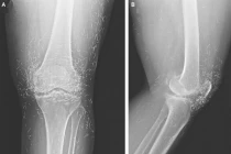  Hàng trăm kim bị bỏ quên trong đầu gối sau châm cứu