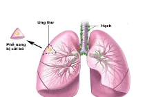 Dấu hiệu bạn bị ung thư phổi
