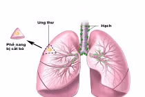 Dấu hiệu bạn bị ung thư phổi
