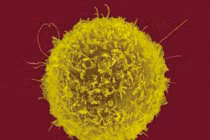 Xem cơ thể chúng ta chiến đấu với ung thư tuyến tụy 