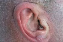 3 loại khối u tai phổ biến