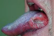 9 nguyên nhân chính dẫn đến ung thư lưỡi