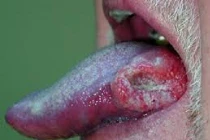 9 nguyên nhân chính dẫn đến ung thư lưỡi