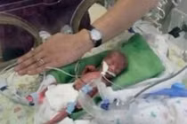 Kì diệu bé gái sinh non 17 tuần sống sót