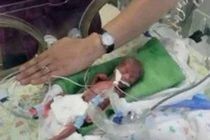 Kì diệu bé gái sinh non 17 tuần sống sót