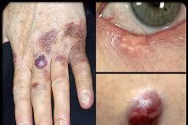 Hình ảnh chứng tỏ bạn bị ung thư da (1)