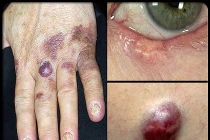 Hình ảnh chứng tỏ bạn bị ung thư da (1)