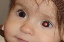 Cảnh báo dấu hiệu ung thư mắt ở trẻ em