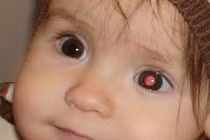 Cảnh báo dấu hiệu ung thư mắt ở trẻ em