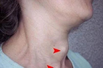 Các dạng ung thư tuyến giáp