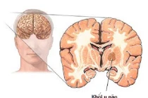 Chủng vi rút sởi có thể tiêu diệt u não trẻ em