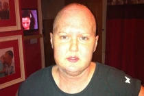 Nghĩ là bệnh đau đầu hóa ra u não ác tính