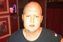 Nghĩ là bệnh đau đầu hóa ra u não ác tính