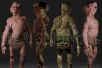 “Người Voi” có thể làm sáng tỏ nguyên nhân gây ung thư