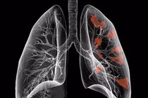 Chỉ 20% ca ung thư phổi thật sự nguy hiểm