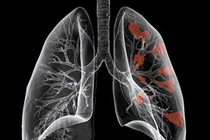 Chỉ 20% ca ung thư phổi thật sự nguy hiểm