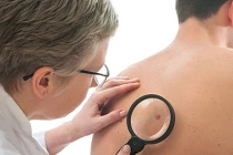 Phát hiện u da ác tính nhờ phương pháp mới 