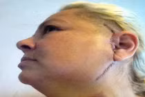 Người phụ nữ cấy ghép hàm titan 16.000 bảng Anh