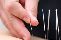 Tác dụng của châm cứu trong điều trị ung thư vú